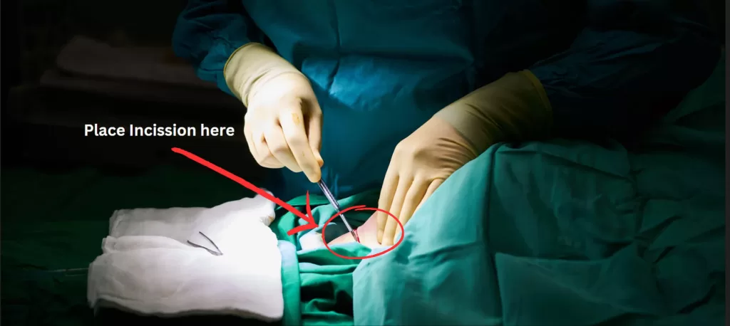 Annotation Using Remote Assist Application with HoloLens in Metaverse Surgery